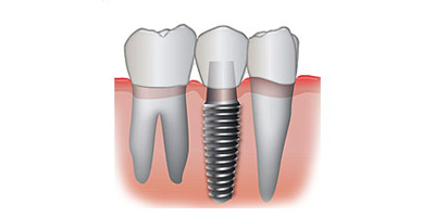 single tooth dental implant single tooth dental implant